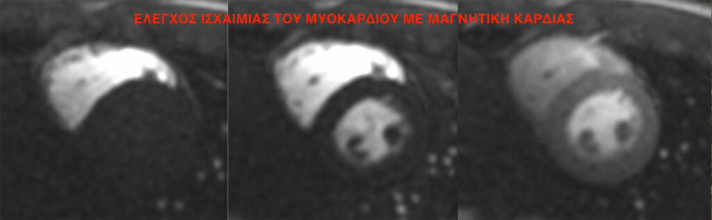 Έλεγχος Ισχαιμίας του Μυοκαρδίου